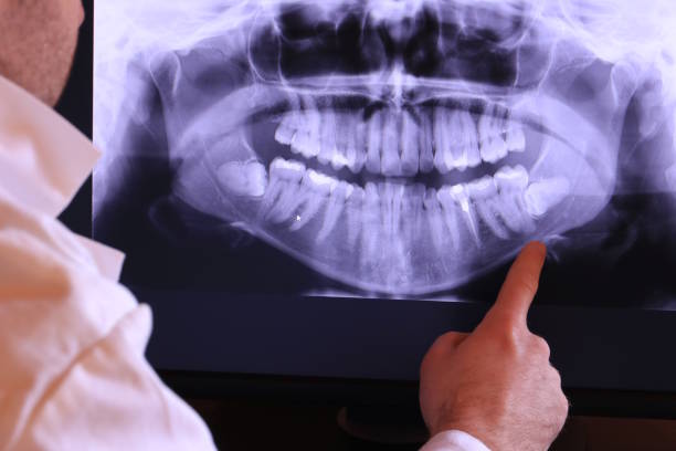 Best Emergency Wisdom Tooth Extraction in Madison, NC
